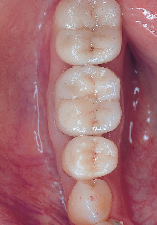 Kiefer Zähne Draufsicht