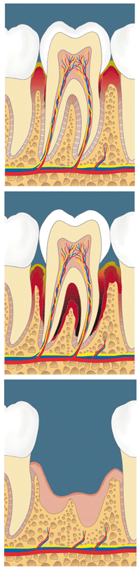 Parodontologie / Paradontitis